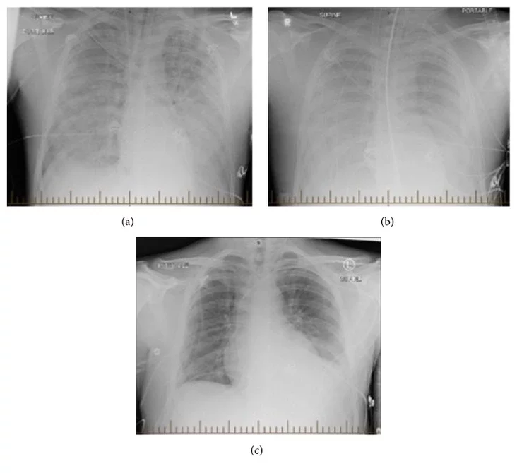 Хантавирусный кардиопульмональный синдром Hantavirus pulmonary syndrome Хантавірусны лёгачны сіндром
